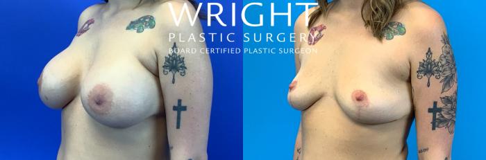 Before & After Breast Lift Case 264 Left Oblique View in Little Rock, Arkansas