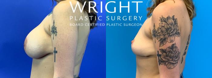 Before & After Breast Implant Removal Case 264 Left Side View in Little Rock, Arkansas