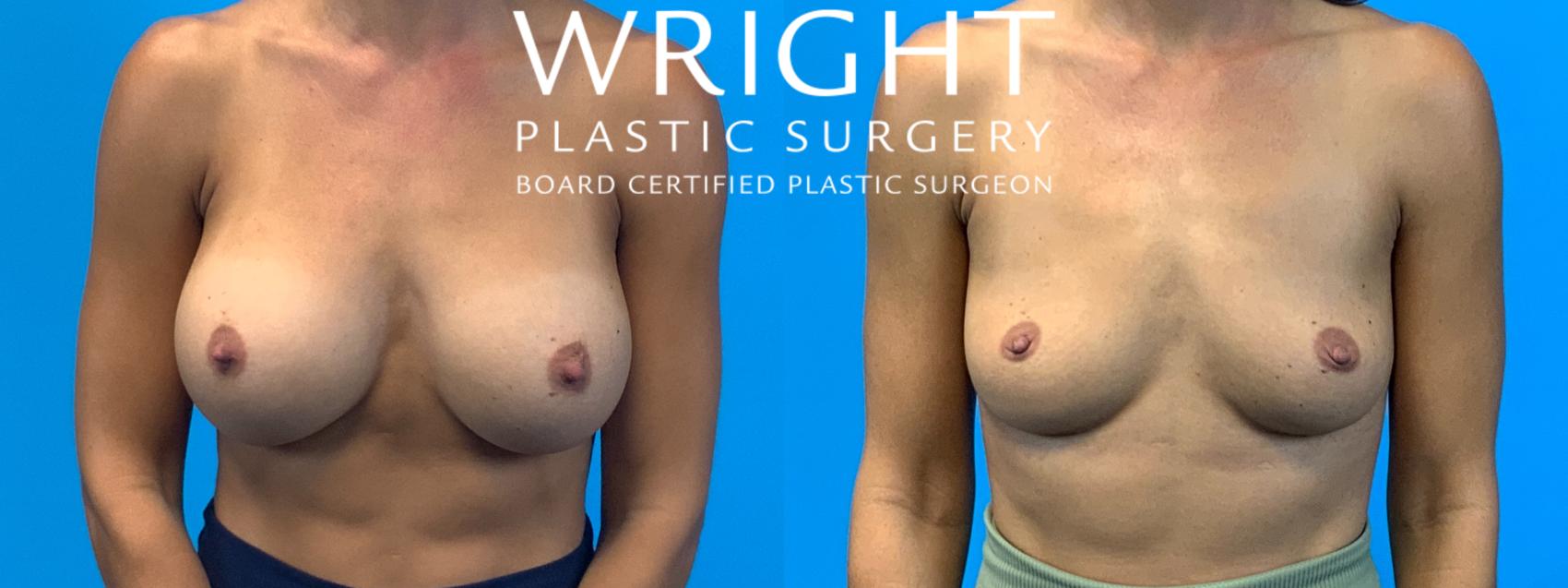 Before & After Breast Implant Removal Case 267 Front View in Little Rock, Arkansas