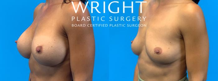Before & After Breast Implant Removal Case 267 Left Oblique View in Little Rock, Arkansas