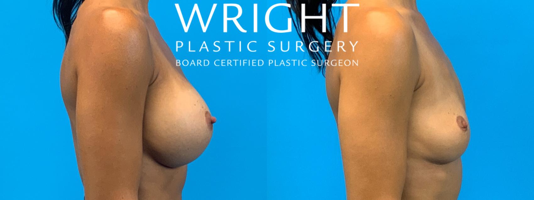 Before & After Breast Implant Removal Case 267 Right Side View in Little Rock, Arkansas