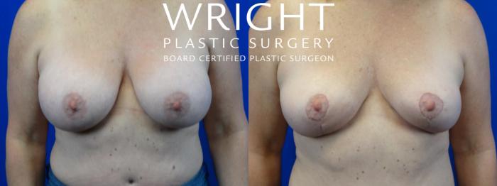 Before & After Breast Implant Removal Case 27 Front View in Little Rock, Arkansas