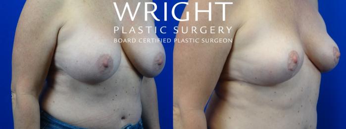 Before & After Breast Lift Case 27 Right Oblique View in Little Rock, Arkansas