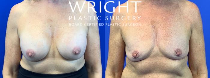 Before & After Breast Implant Removal Case 275 Front View in Little Rock, Arkansas