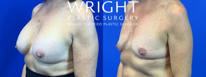 Before & After Breast Implant Removal Case 275 Left Oblique View in Little Rock, Arkansas