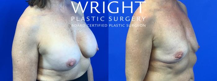 Before & After Breast Implant Removal Case 275 Right Oblique View in Little Rock, Arkansas