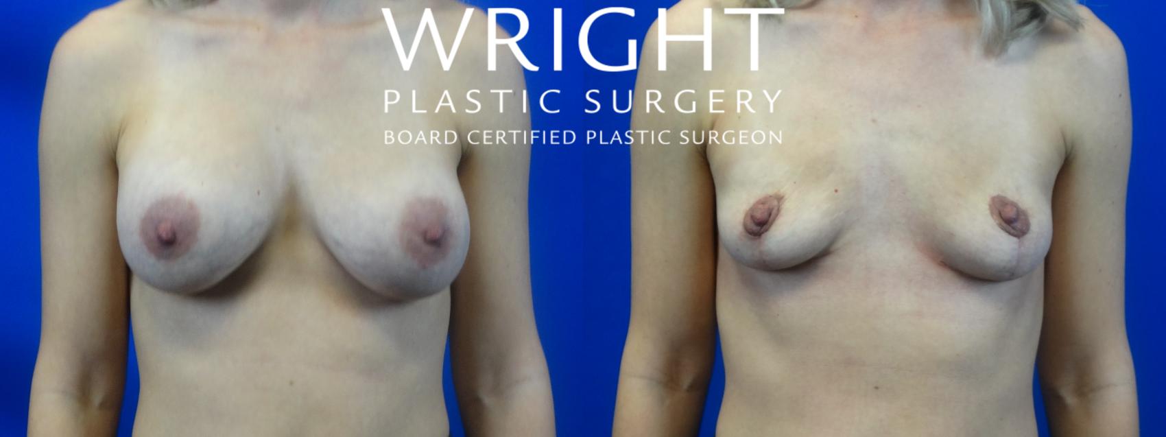 Before & After Breast Lift Case 28 Front View in Little Rock, Arkansas