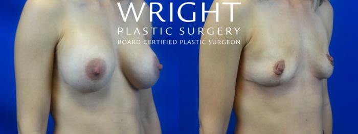 Before & After Breast Implant Removal Case 28 Right Oblique View in Little Rock, Arkansas