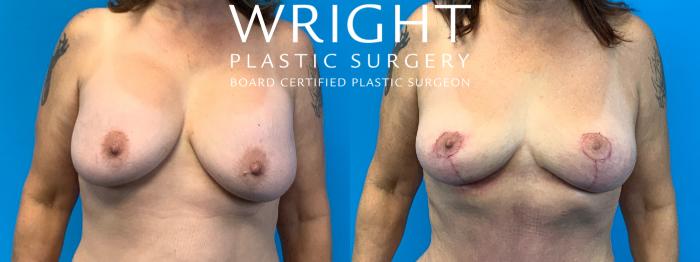 Before & After Breast Implant Removal Case 282 Front View in Little Rock, Arkansas