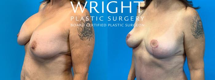 Before & After Breast Lift Case 282 Left Oblique View in Little Rock, Arkansas