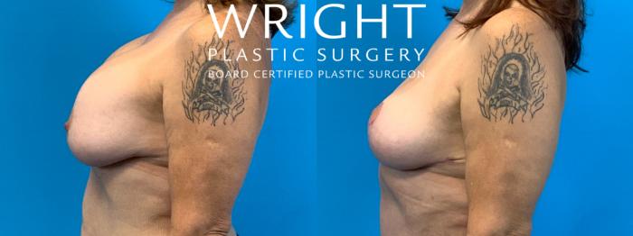 Before & After Breast Lift Case 282 Left Side View in Little Rock, Arkansas