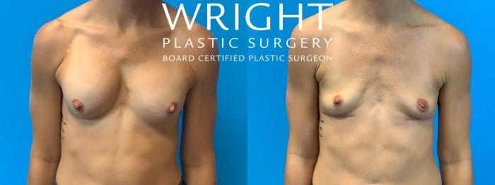Before & After Breast Implant Removal Case 283 Front View in Little Rock, Arkansas