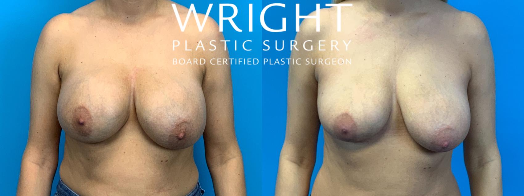 Before & After Breast Implant Removal Case 285 Front View in Little Rock, Arkansas