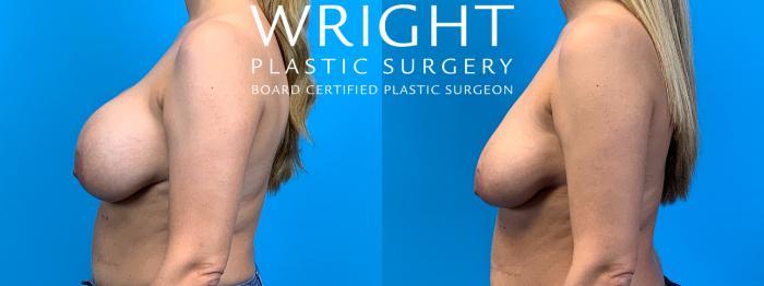 Before & After Breast Implant Removal Case 285 Left Side View in Little Rock, Arkansas