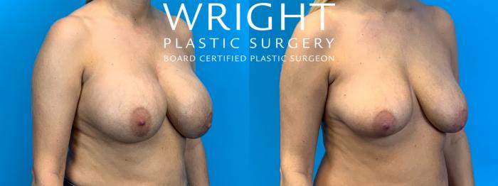 Before & After Breast Implant Removal Case 285 Right Oblique View in Little Rock, Arkansas