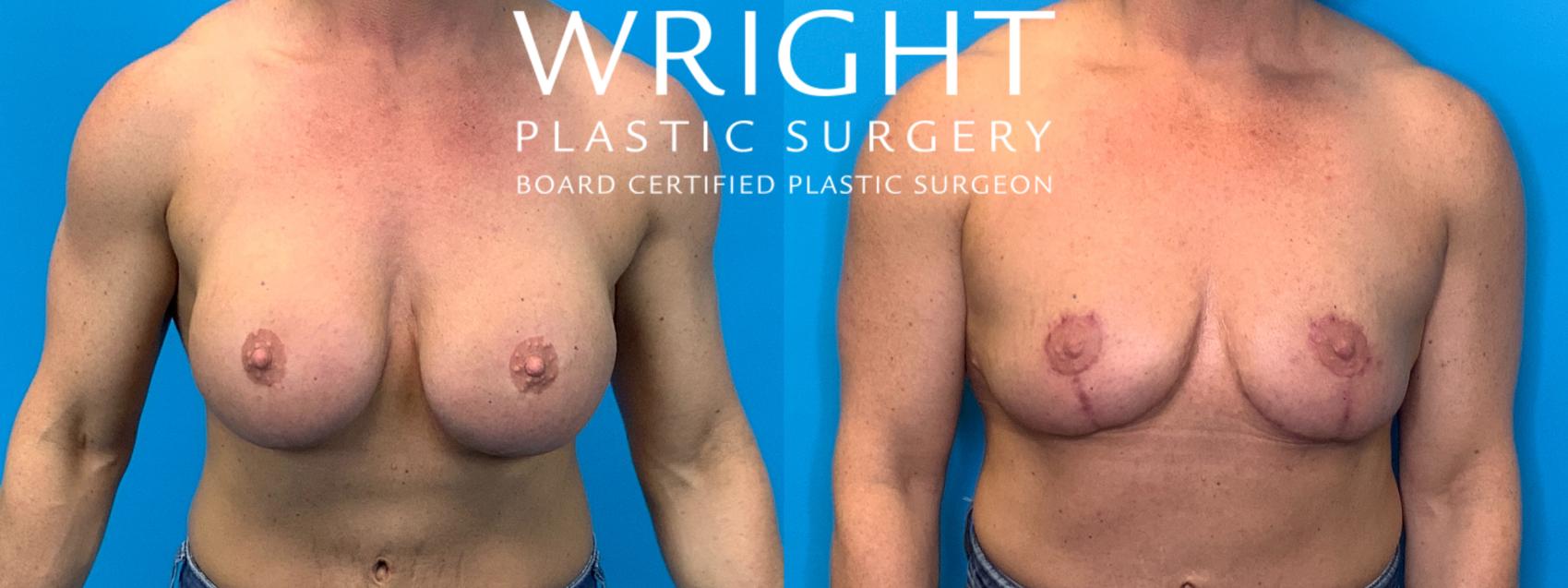Before & After Breast Implant Removal Case 287 Front View in Little Rock, Arkansas