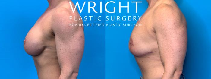 Before & After Breast Implant Removal Case 287 Left Side View in Little Rock, Arkansas
