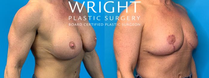 Before & After Breast Implant Removal Case 287 Right Oblique View in Little Rock, Arkansas
