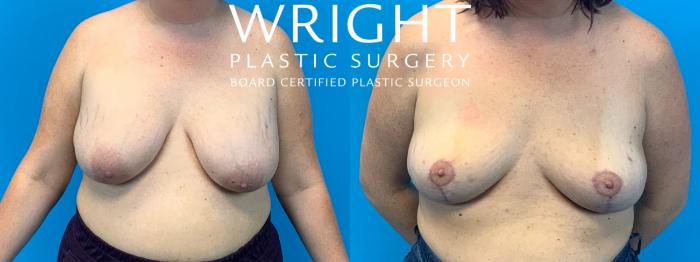 Before & After Breast Implant Removal Case 289 Front View in Little Rock, Arkansas