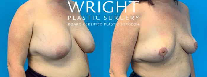 Before & After Breast Implant Removal Case 289 Right Oblique View in Little Rock, Arkansas