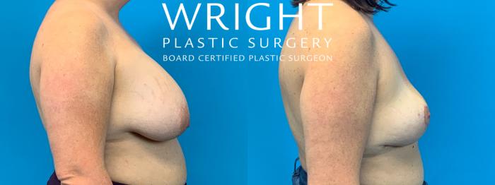 Before & After Breast Lift Case 289 Right Side View in Little Rock, Arkansas