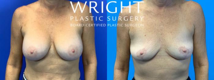 Before & After Breast Implant Removal Case 293 Front View in Little Rock, Arkansas