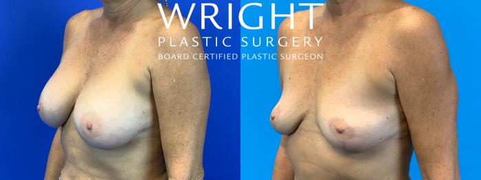 Before & After Breast Lift Case 293 Left Oblique View in Little Rock, Arkansas