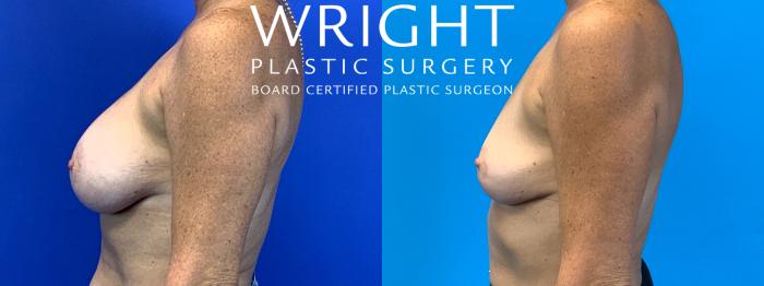 Before & After Breast Lift Case 293 Left Side View in Little Rock, Arkansas
