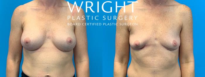 Before & After Breast Implant Removal Case 296 Front View in Little Rock, Arkansas