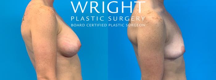 Before & After Breast Implant Removal Case 296 Right Side View in Little Rock, Arkansas