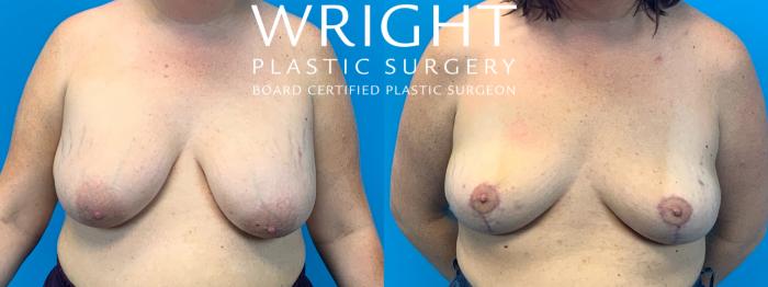 Before & After Breast Implant Removal Case 297 Front View in Little Rock, Arkansas