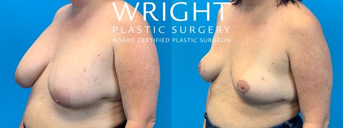 Before & After Breast Implant Removal Case 297 Left Oblique View in Little Rock, Arkansas