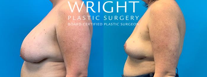 Before & After Breast Implant Removal Case 297 Left Side View in Little Rock, Arkansas