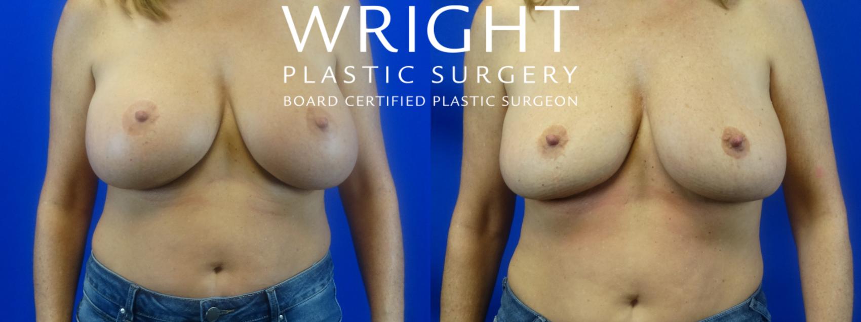 Before & After Breast Implant Removal Case 3 Front View in Little Rock, Arkansas