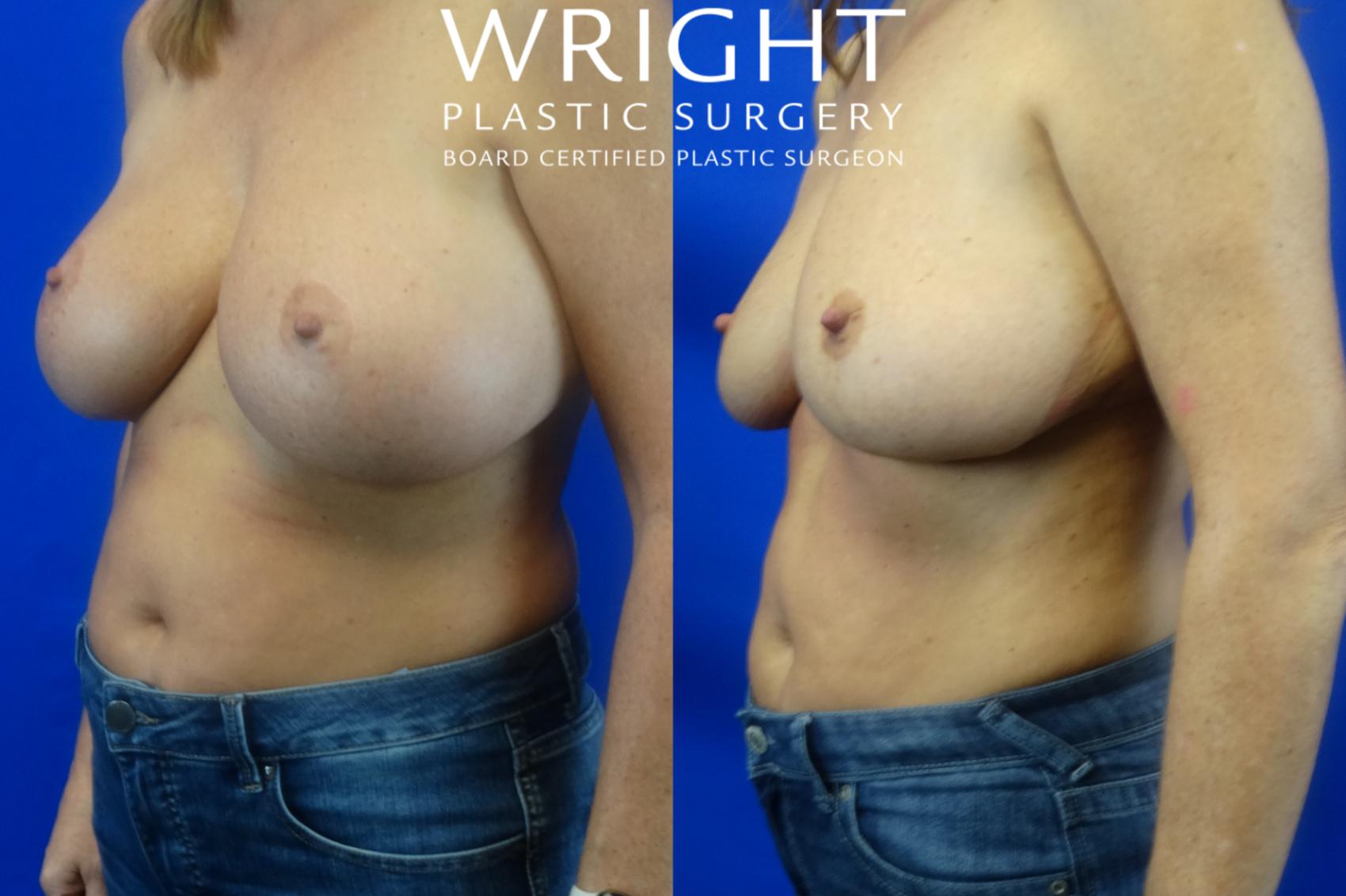 Before & After Breast Implant Removal Case 3 Left Oblique View in Little Rock, Arkansas