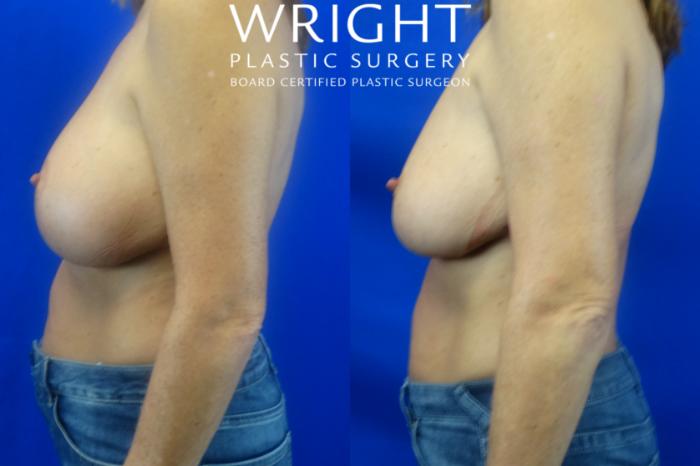 Before & After Breast Implant Removal Case 3 Left Side View in Little Rock, Arkansas