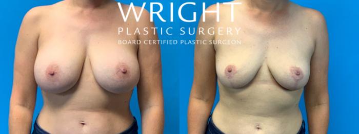 Before & After Breast Implant Removal Case 308 Front View in Little Rock, Arkansas