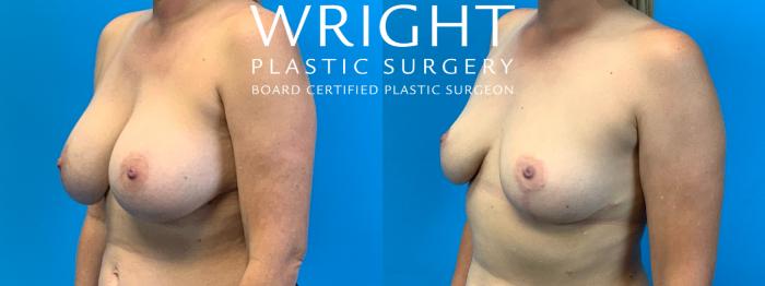 Before & After Breast Implant Removal Case 308 Left Oblique View in Little Rock, Arkansas