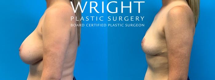 Before & After Breast Implant Removal Case 308 Left Side View in Little Rock, Arkansas