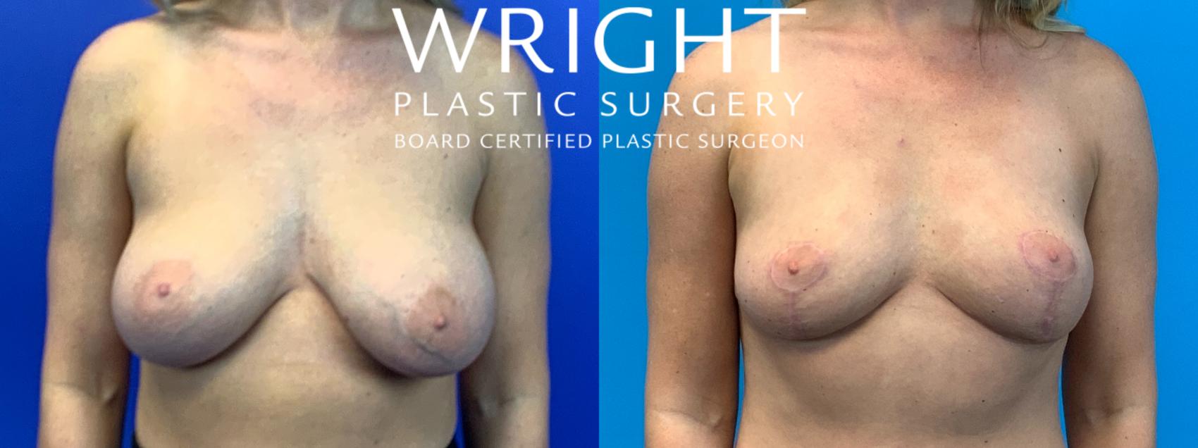 Before & After Breast Implant Removal Case 309 Front View in Little Rock, Arkansas