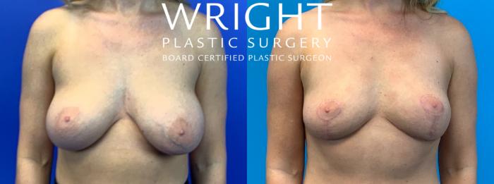 Before & After Breast Lift Case 309 Front View in Little Rock, Arkansas