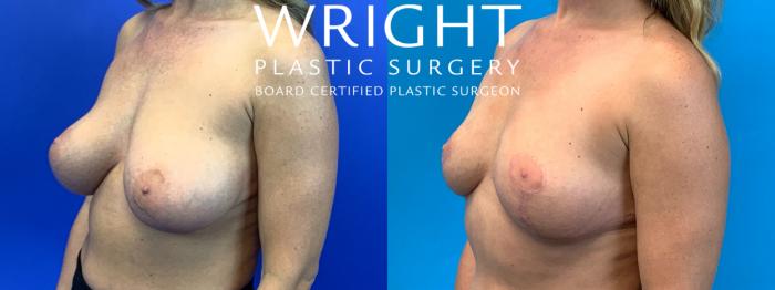 Before & After Breast Lift Case 309 Left Oblique View in Little Rock, Arkansas