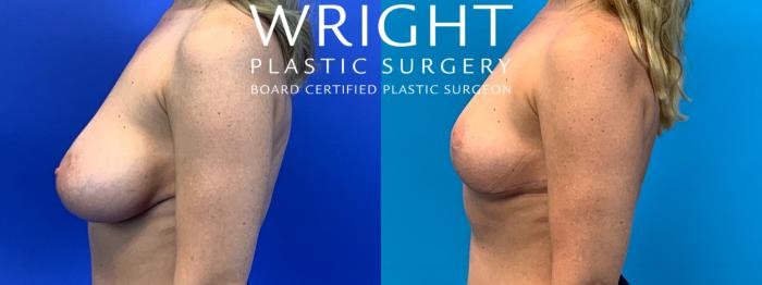 Before & After Breast Implant Removal Case 309 Left Side View in Little Rock, Arkansas