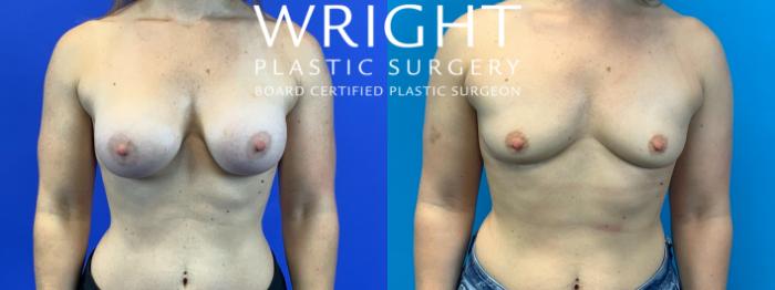 Before & After Breast Implant Removal Case 312 Front View in Little Rock, Arkansas