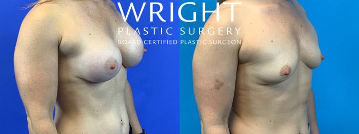 Before & After Breast Implant Removal Case 312 Right Oblique View in Little Rock, Arkansas