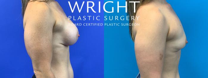Before & After Breast Implant Removal Case 312 Right Side View in Little Rock, Arkansas
