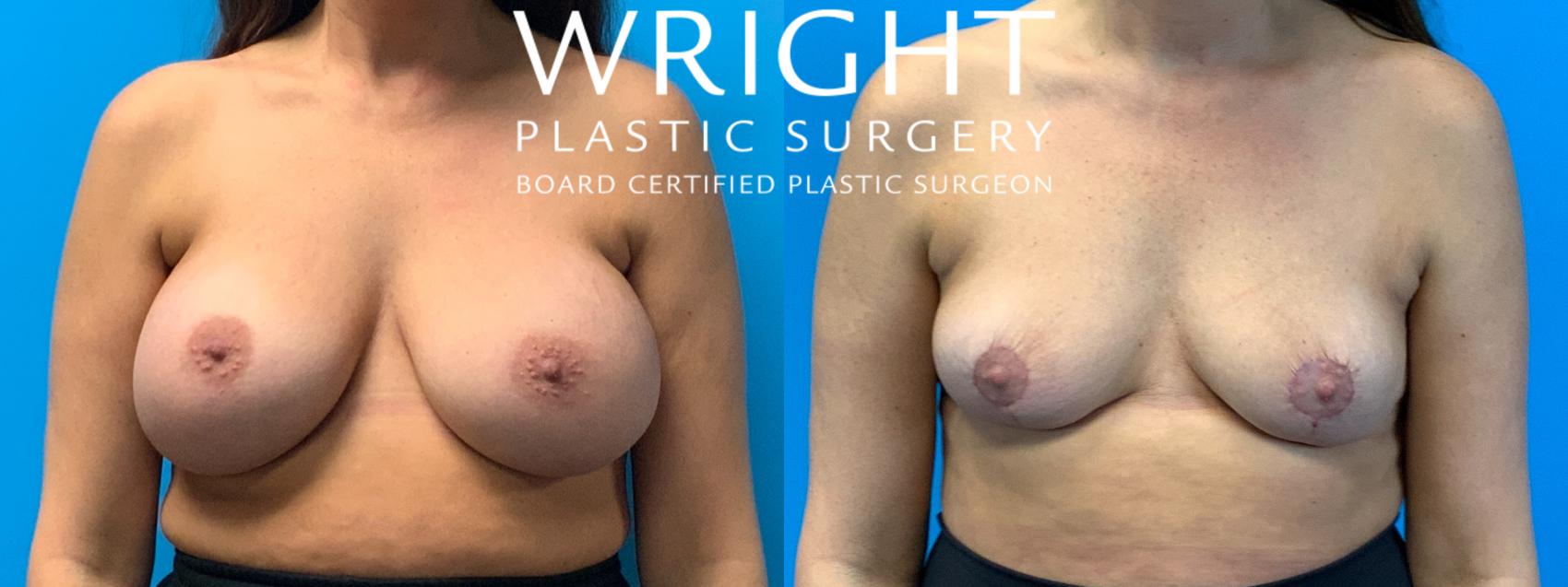 Before & After Breast Implant Removal Case 315 Front View in Little Rock, Arkansas