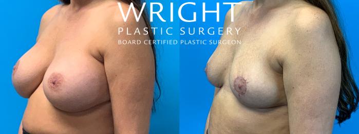Before & After Breast Implant Removal Case 315 Left Oblique View in Little Rock, Arkansas