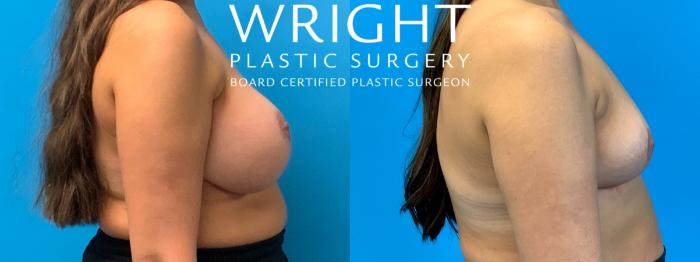 Before & After Breast Implant Removal Case 315 Right Side View in Little Rock, Arkansas