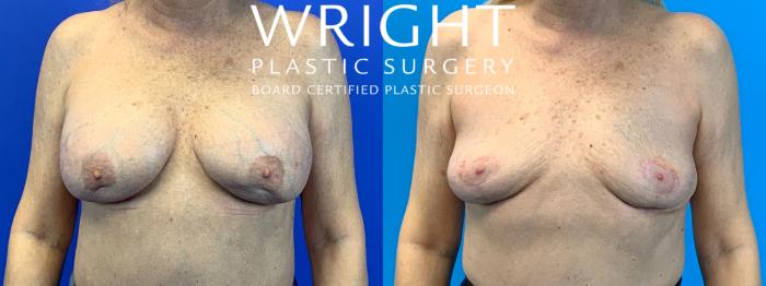 Before & After Breast Lift Case 316 Front View in Little Rock, Arkansas